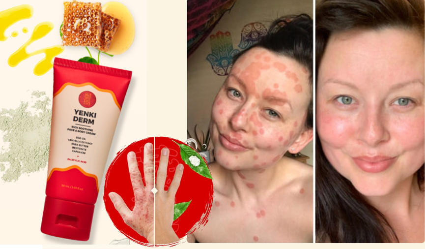 Jak Stosować Yenki Derm? Instrukcja i ulotka